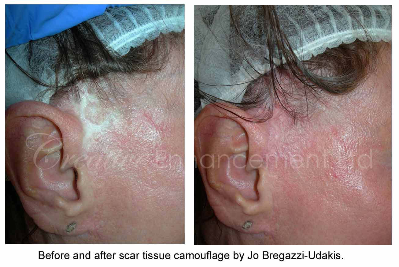 About Face And Body  Permanent Makeup Medical Tattooing Scar Camouflage   Yes we do tattoo removal Removal of tattooed freckles is a frequent  request we get  Facebook